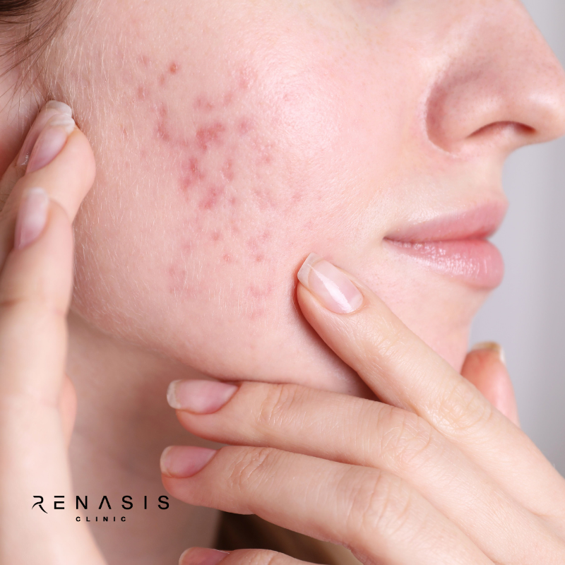 Facial Antibrillo y Acné