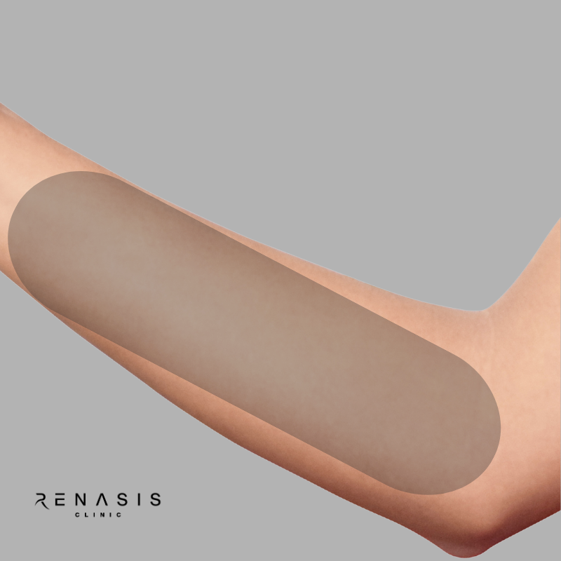 Antebrazo | Depilación Láser
