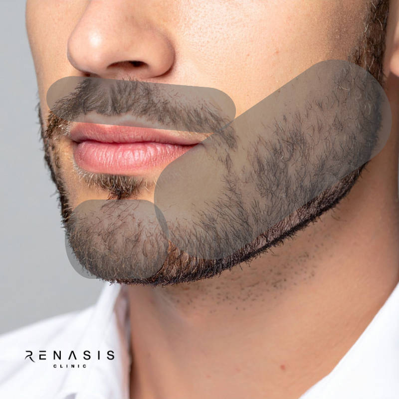 Barba completa hombre | Depilación Láser