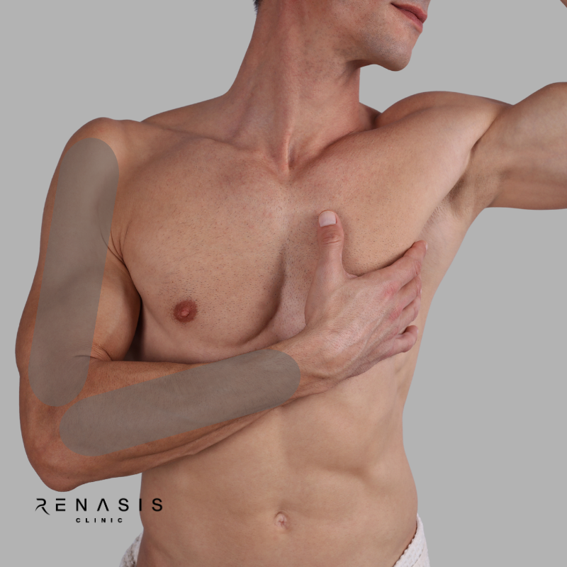 Brazo completo hombre | Depilación Láser