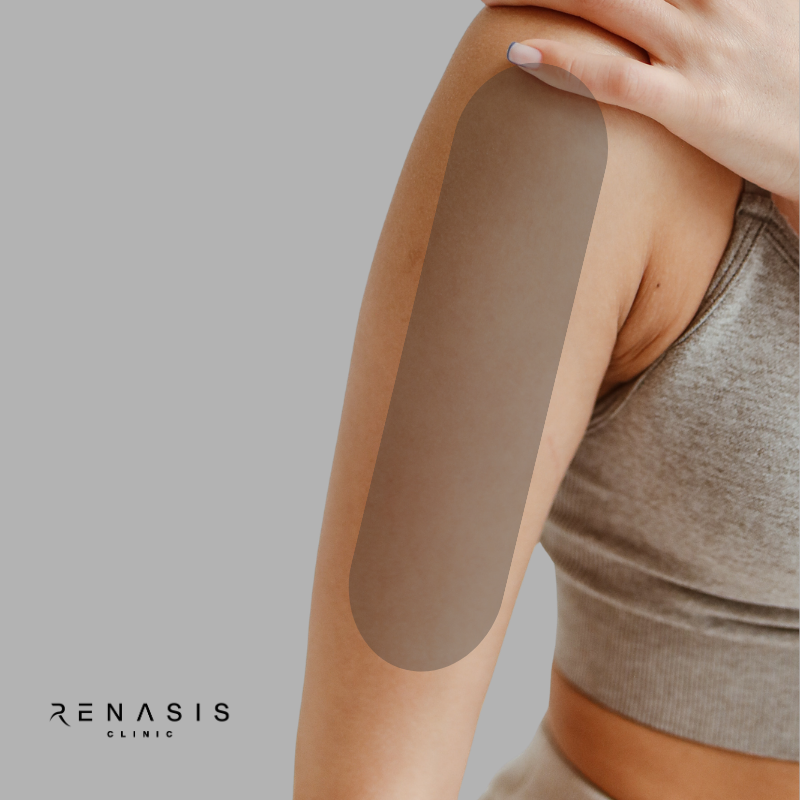Brazo superior | Depilación Láser
