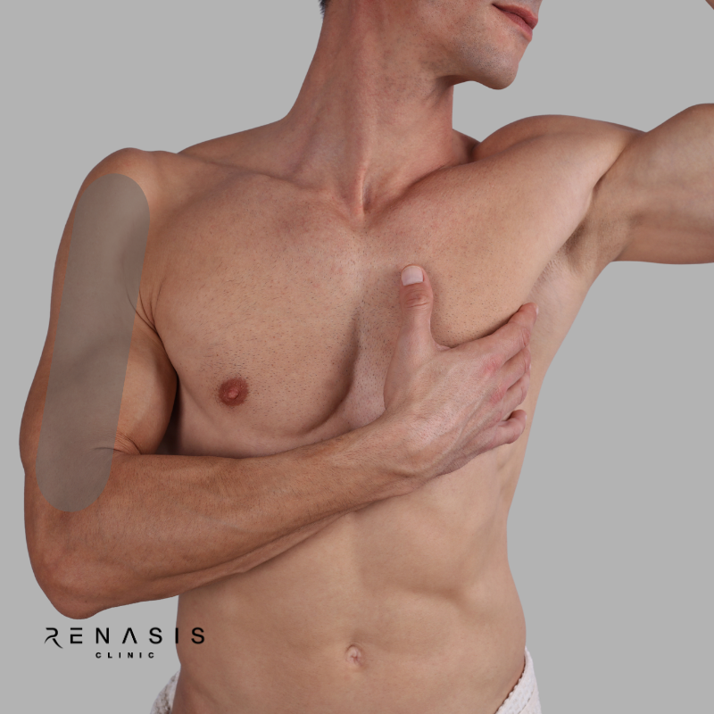 Brazo superior hombre | Depilación Láser