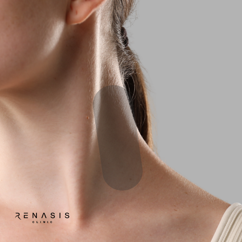 Cuello anterior | Depilación Láser