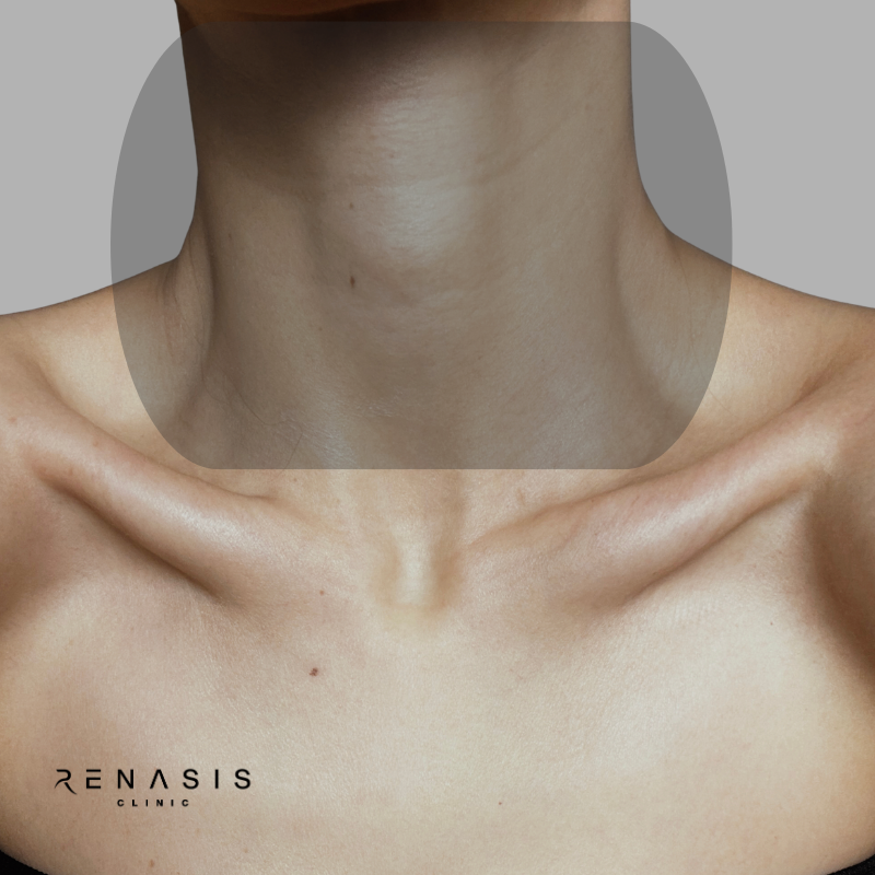 Cuello completo | Depilación Láser