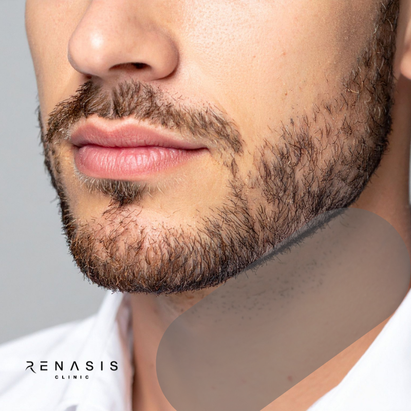 Cuello completo hombre | Depilación Láser