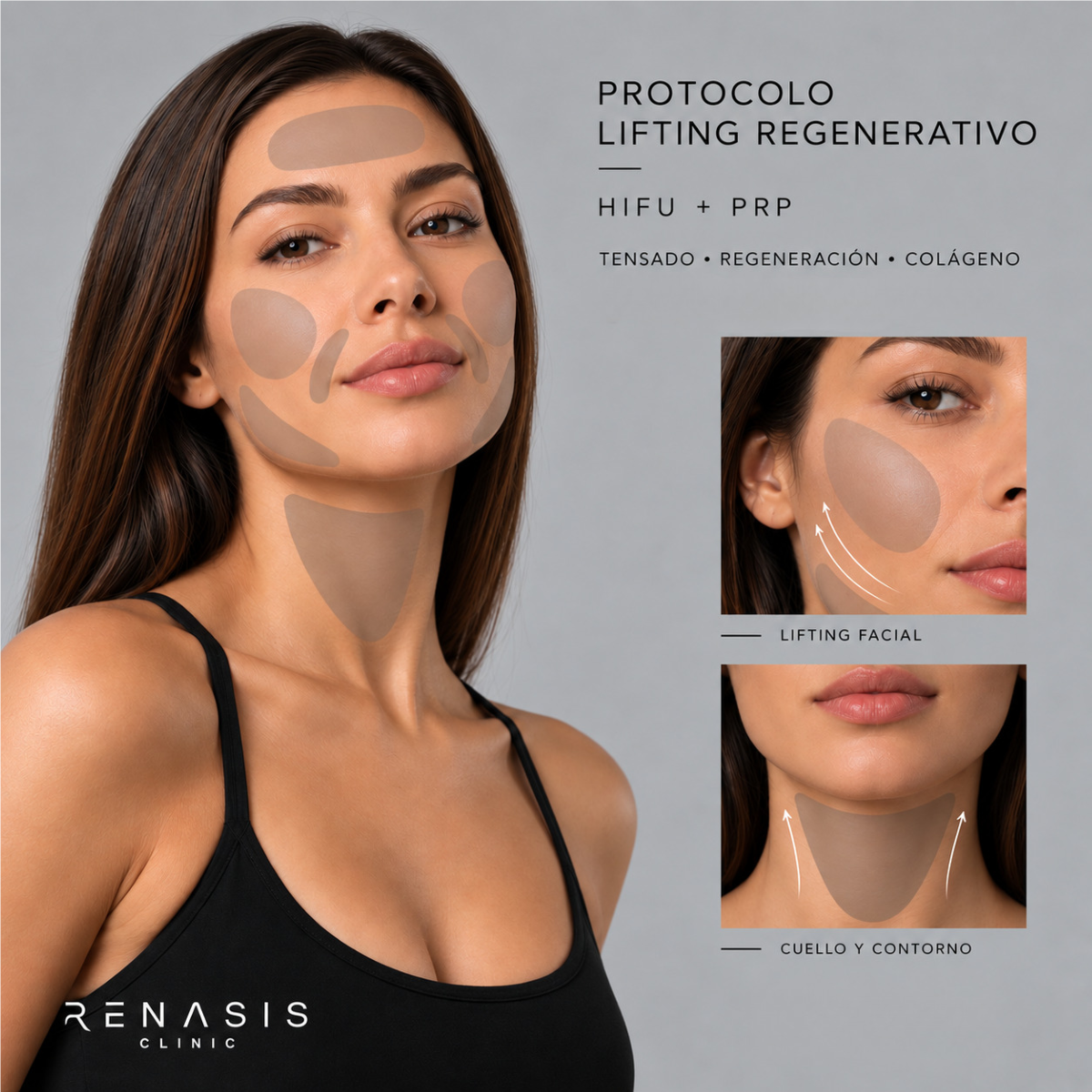 Protocolo Lifting Regenerativo (HIFU + PRP)