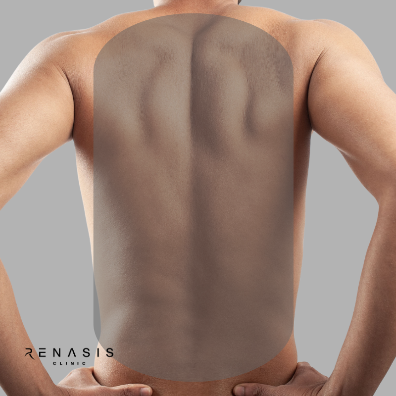 Espalda completa hombre | Depilación Láser