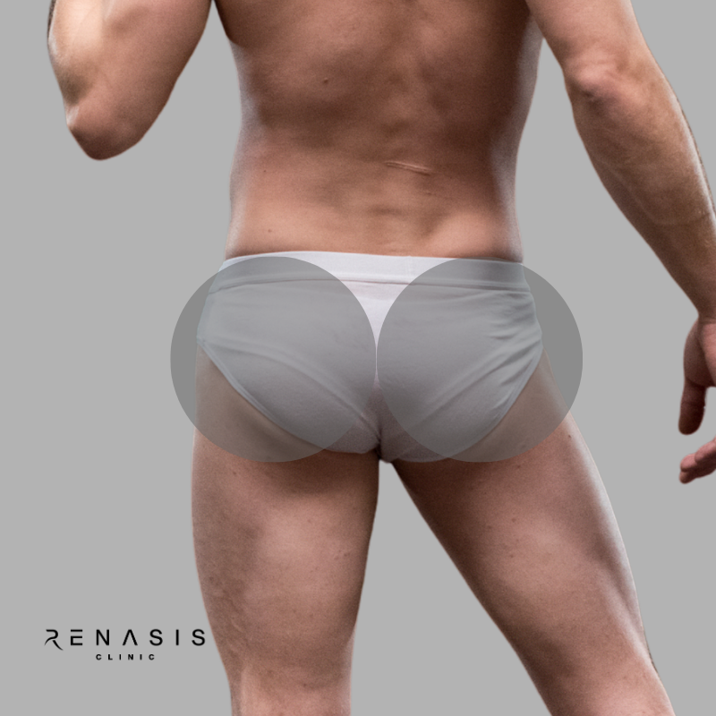 Glúteos hombre | Depilación Láser
