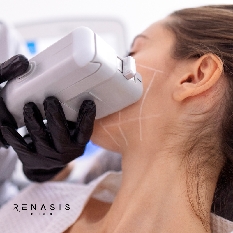 HIFU Facial Completo