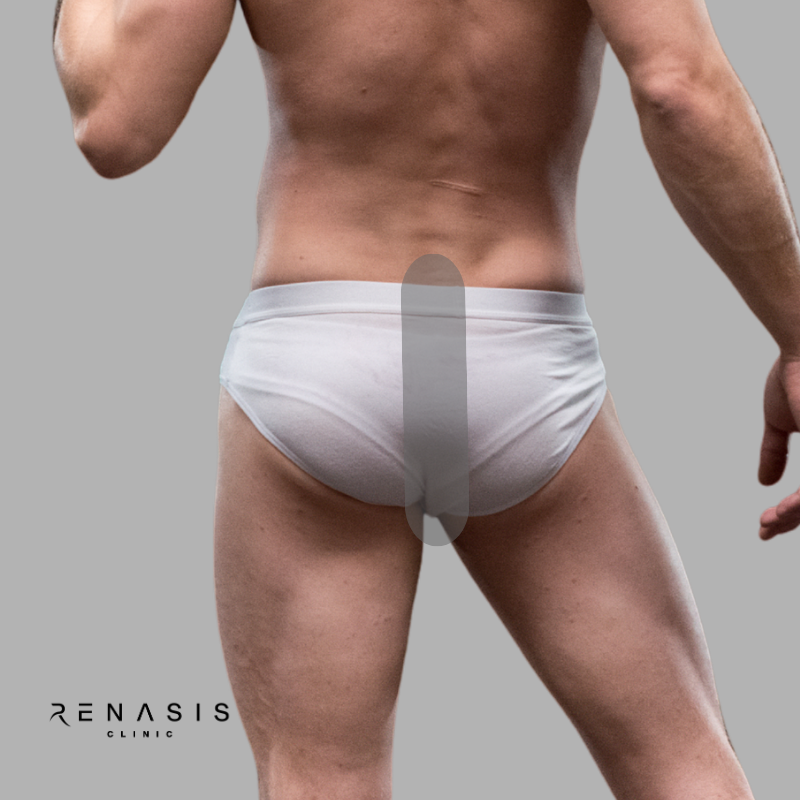 Interglúteos hombre | Depilación Láser