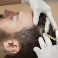 Minoxidil con Dermapen