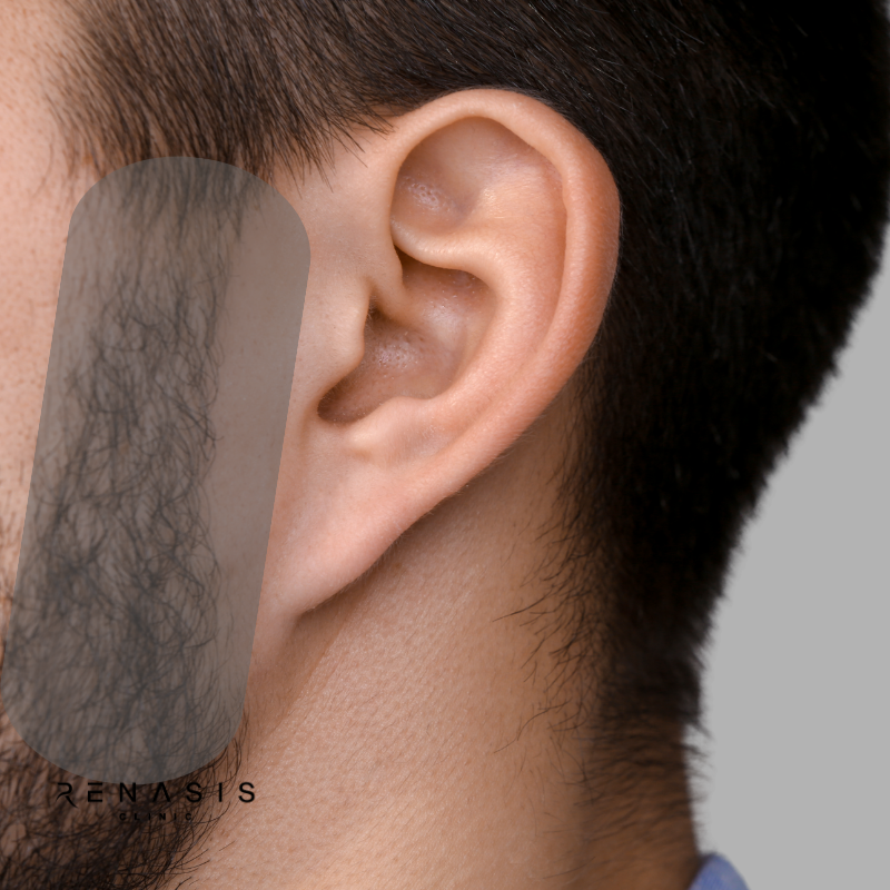 Patillas hombre | Depilación Láser